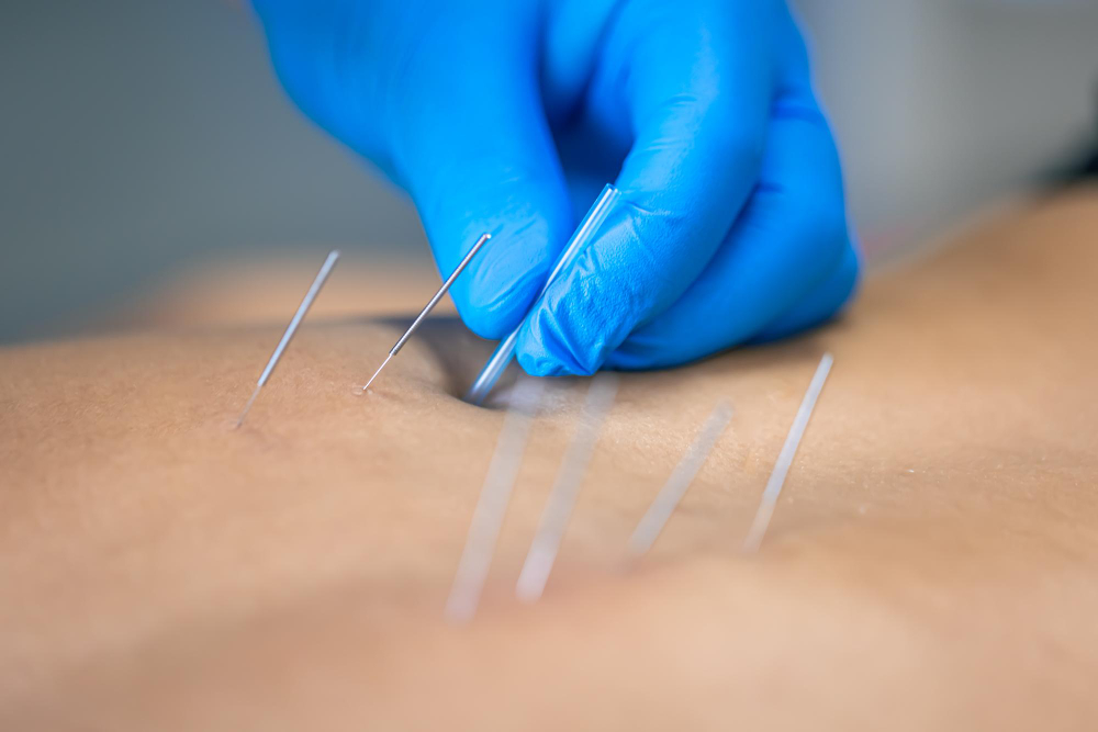 Dry Needling Therapy Plymouth