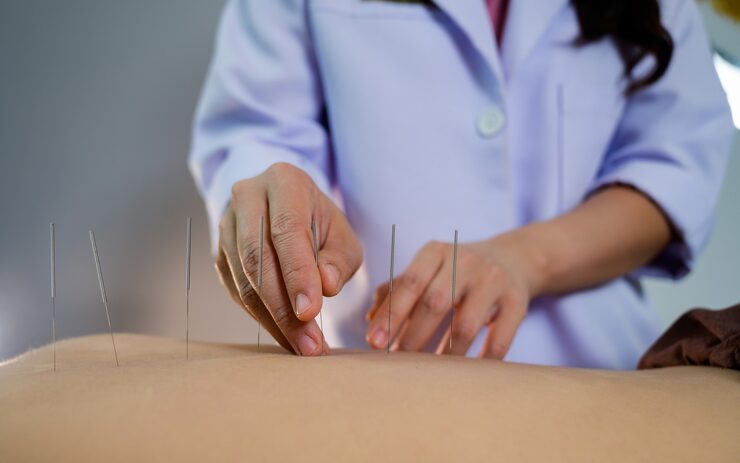 Dry Needling Therapy